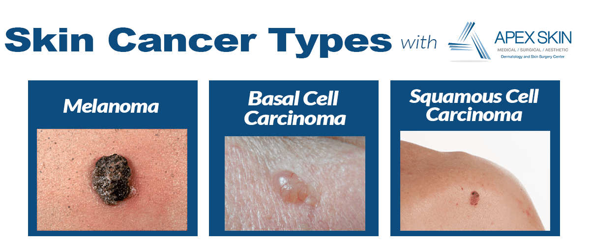 4 Types Of Skin Cancer
