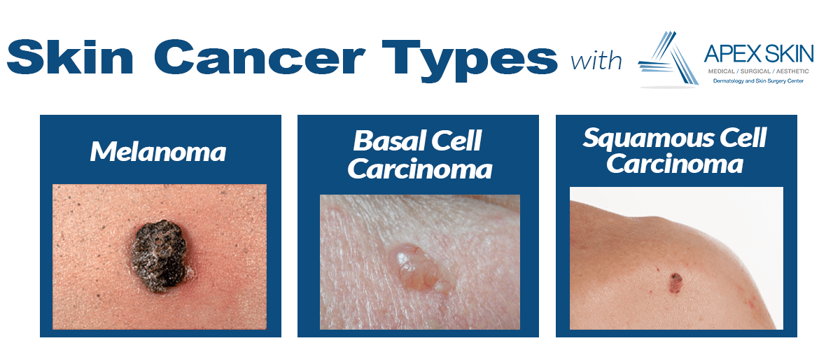 Different Types Of Skin Cancer Treatments